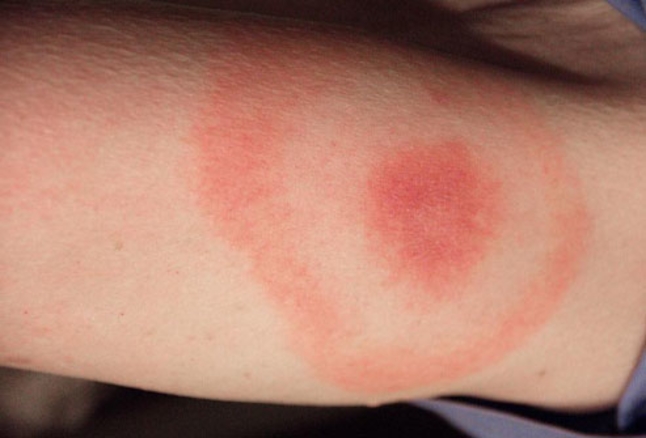 bullseye rash tick bite